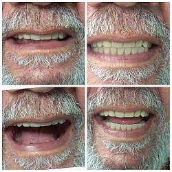 Protocolo de implantes